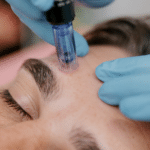 Close-up of a person receiving a microneedling treatment on the forehead from a practitioner wearing blue gloves.
